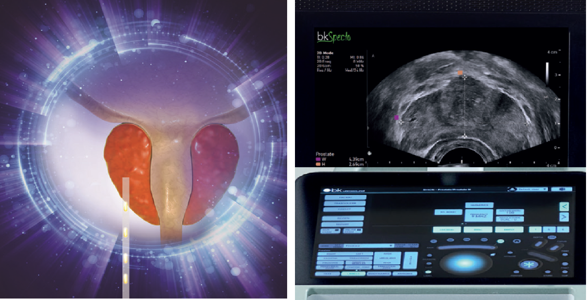 prostat genel ve usg